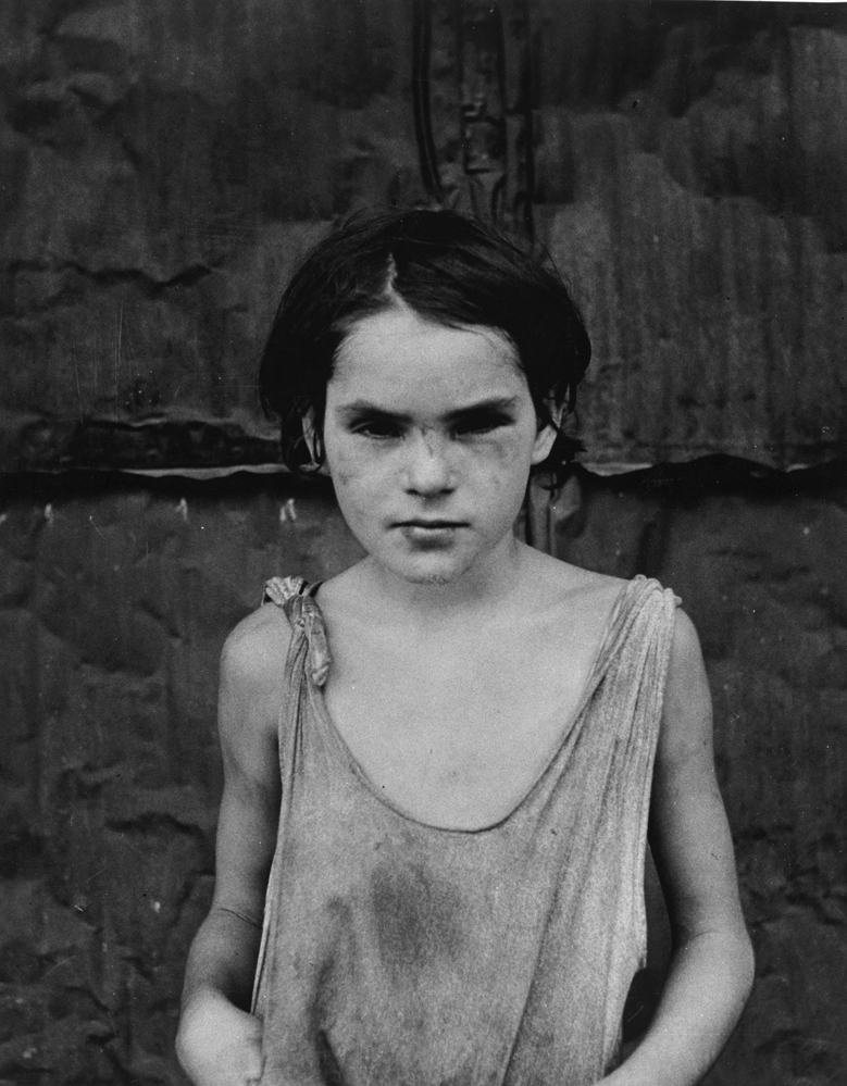 Damaged Child, Shacktown, Elm Grove, Oklahoma,
                  1936 Dorothea Lange